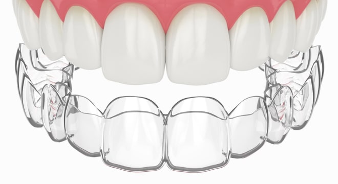 Clear removable retainer